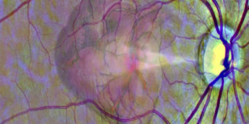 Καλλιτεχνική απεικόνιση της βασικής ιδέας του πώς μέσα από τα μάτια «διαβάζεται» ο κίνδυνος εμφράγματος (πηγή: University of Leeds)