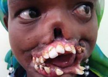 Σοκ προκαλεί η νέα ασθένεια που πλήττει την Αφρική