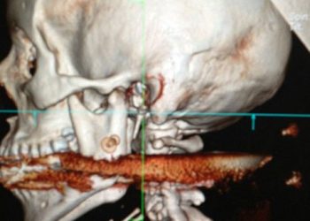 Κάρφωσε το ψαροτούφεκο στο στόμα της γυναίκας του