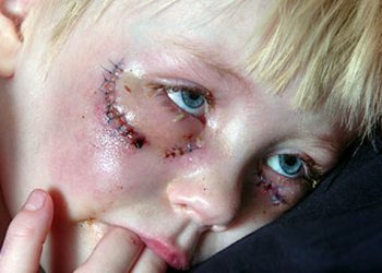 Πέντε παιδιά το μήνα σωματικά και σεξουαλικά κακοποιημένα