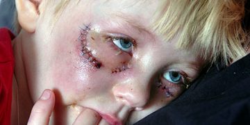 Πέντε παιδιά το μήνα σωματικά και σεξουαλικά κακοποιημένα