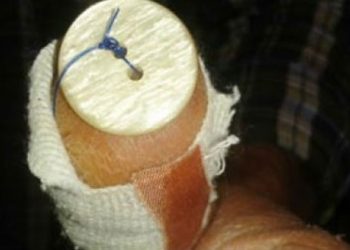 Του έκλεισαν την πληγή με ... κουμπί σε δημόσιο νοσοκομείο!