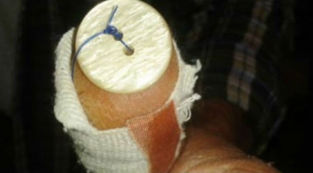 Του έκλεισαν την πληγή με ... κουμπί σε δημόσιο νοσοκομείο!