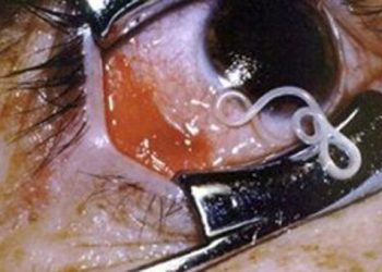 Απίστευτο: Είχε μέσα στο μάτι του... σκουλήκι