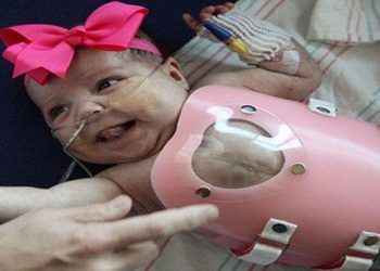 Γεννήθηκε με την καρδιά έξω από το στήθος