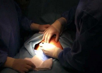 Πώς συνδέεται η καισαρική με το βάρος των παιδιών
