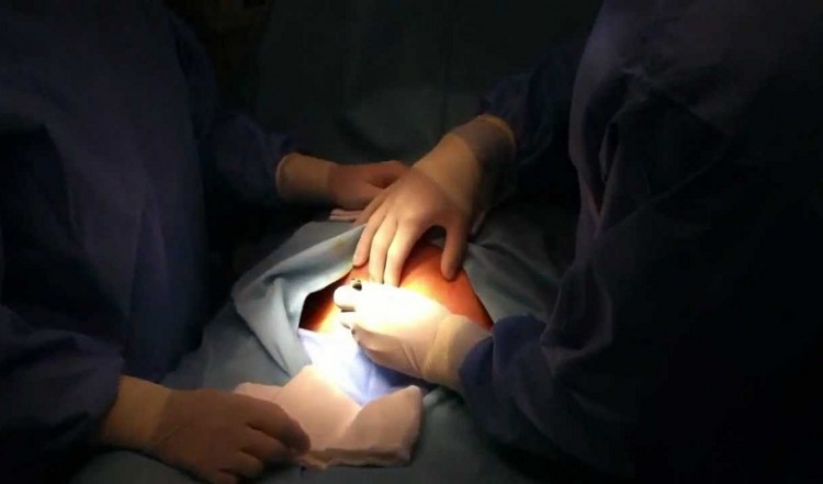 Πώς συνδέεται η καισαρική με το βάρος των παιδιών