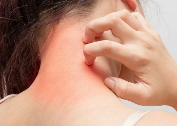Έκζεμα: Ποιες τροφές πρέπει να αποφεύγουμε