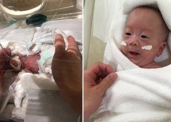 Κέρδισε τη μάχη το μικρότερο νεογέννητο στον κόσμο – Ζύγιζε 268 γραμμάρια!