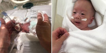 Κέρδισε τη μάχη το μικρότερο νεογέννητο στον κόσμο – Ζύγιζε 268 γραμμάρια!