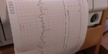 Πρόωρη εμμηνόπαυση και χρόνια προβλήματα υγείας