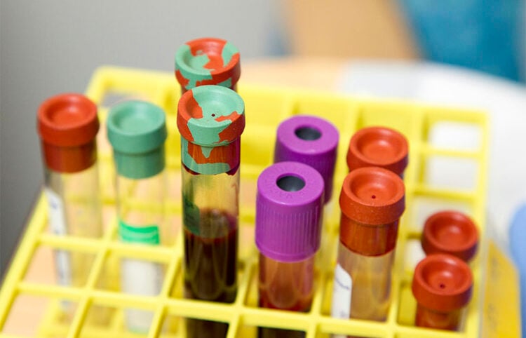 Δείγματα αίματος στο Κλινικό Κέντρο των Εθνικών Ινστιτούτων Υγείας των ΗΠΑ – Φωτογραφία αρχείου (φωτ.: National Cancer Institute / Daniel Sone)